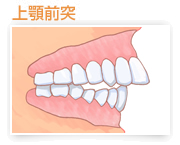 上顎前突