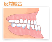 反対咬合