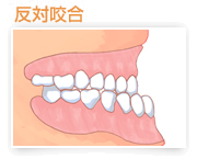 反対咬合